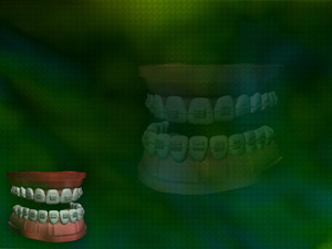 Dental Braces Title Content PowerPoint Template