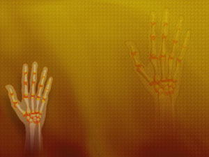Rheumatoid Arthritis Title Content PowerPoint Template